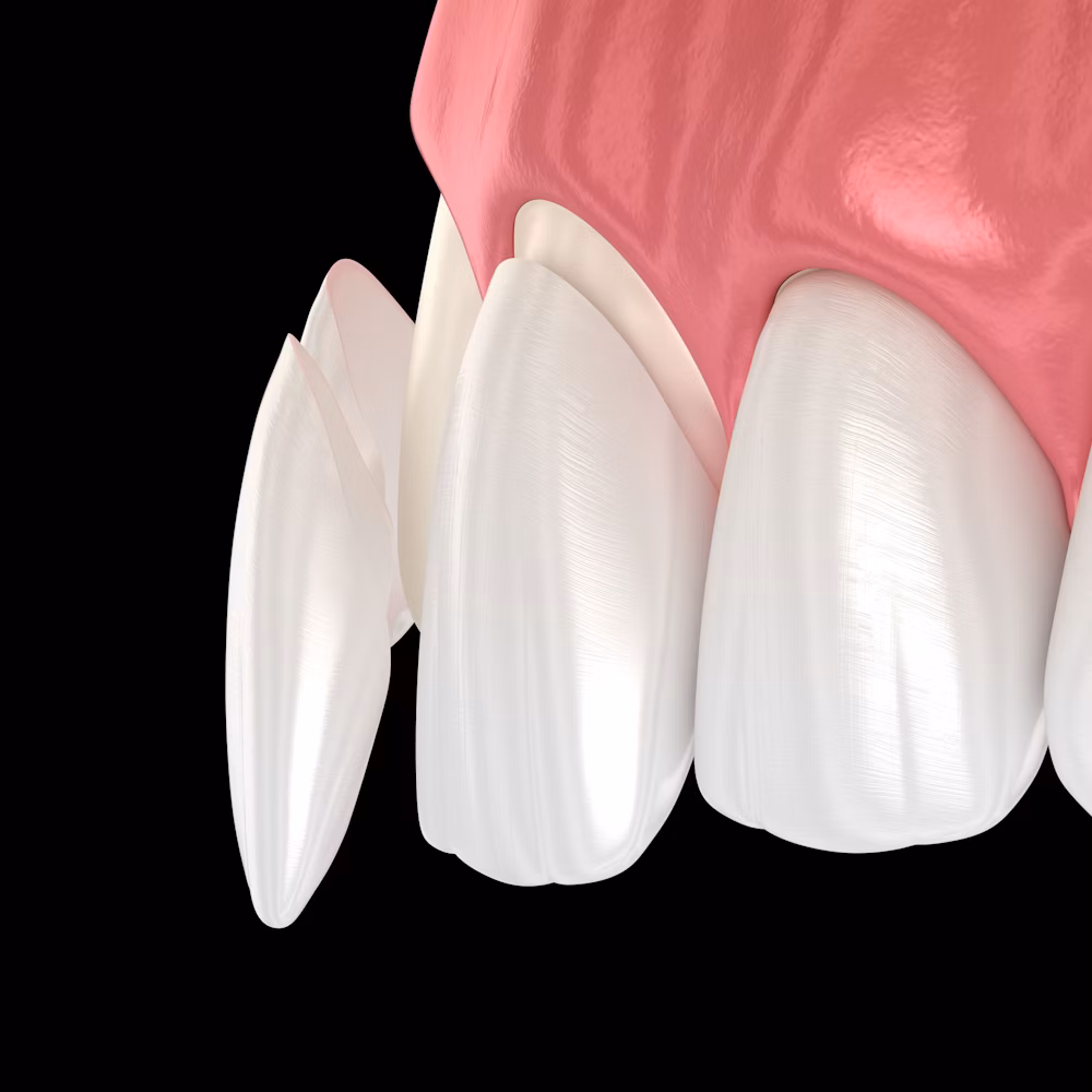 dental veneers