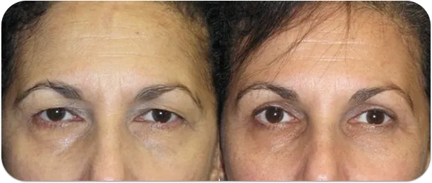 before and after facial surgery