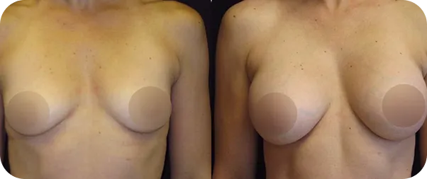 before and after breast surgery