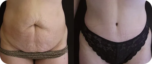before and after body contouring