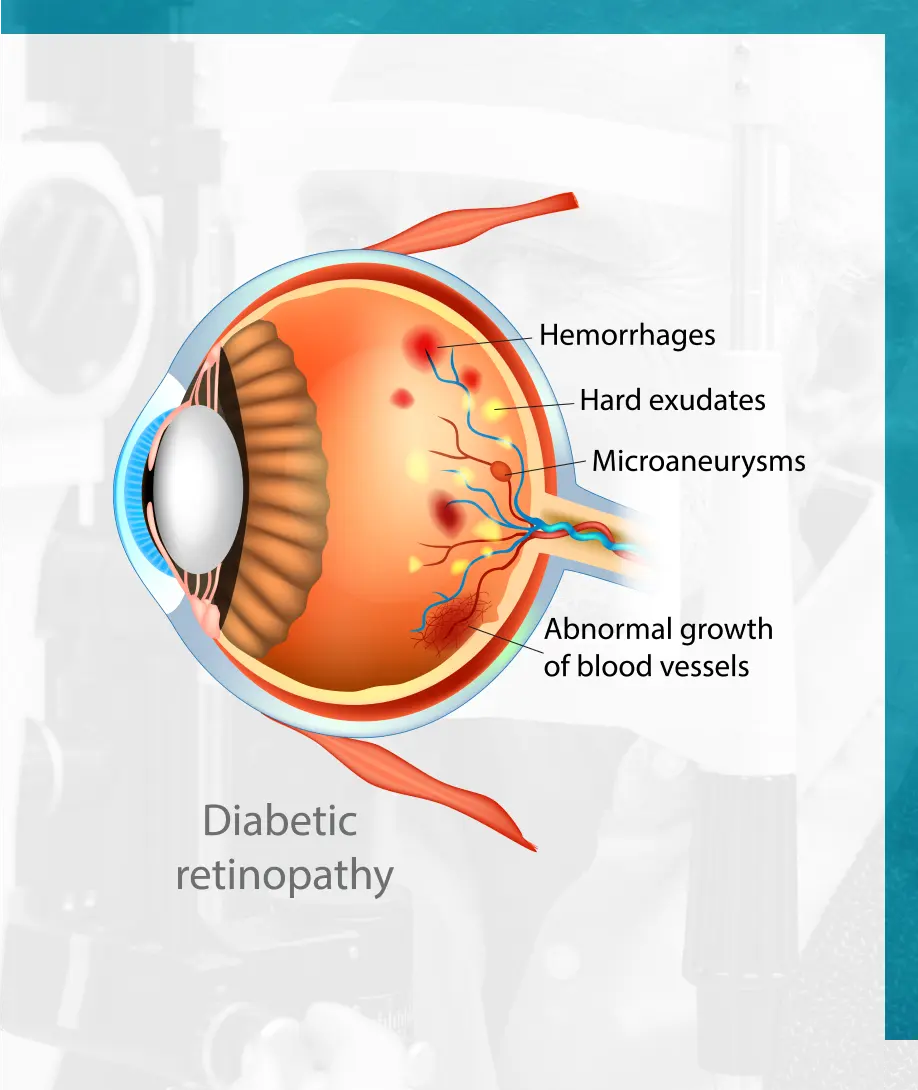 illustration of the effects of diabetic retinopathy