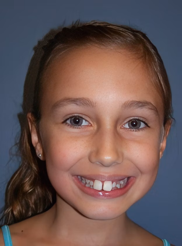 Dr. Kellyn Hodges' patient before orthodontics