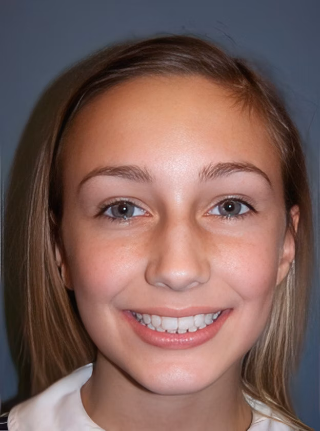 Dr. Kellyn Hodges' patient before and after orthodontics