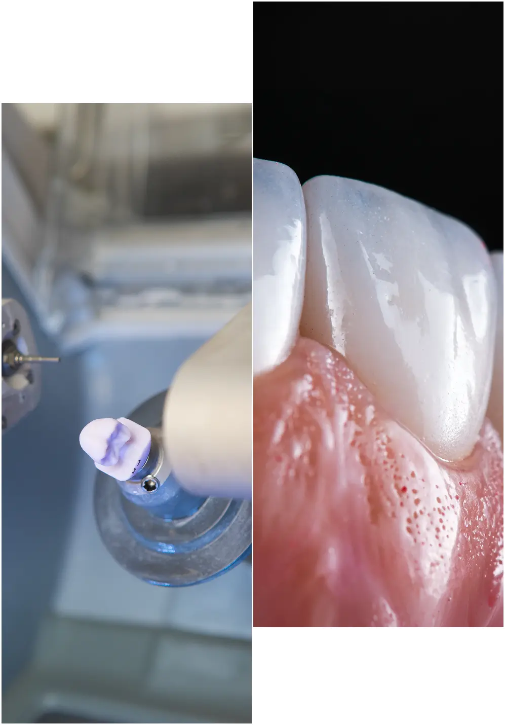 Close-up of a CEREC milling unit shaping a ceramic dental crown beside a detailed view of a white porcelain crown seated on a prepared tooth and surrounding gum tissue
