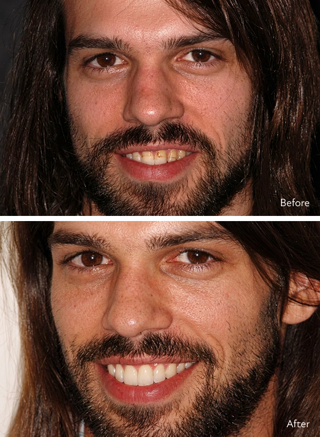 Before and after of a smiling male patient with long hair and facial hair, showing a transformation from discolored, uneven teeth to a bright, even smile after cosmetic dental treatment