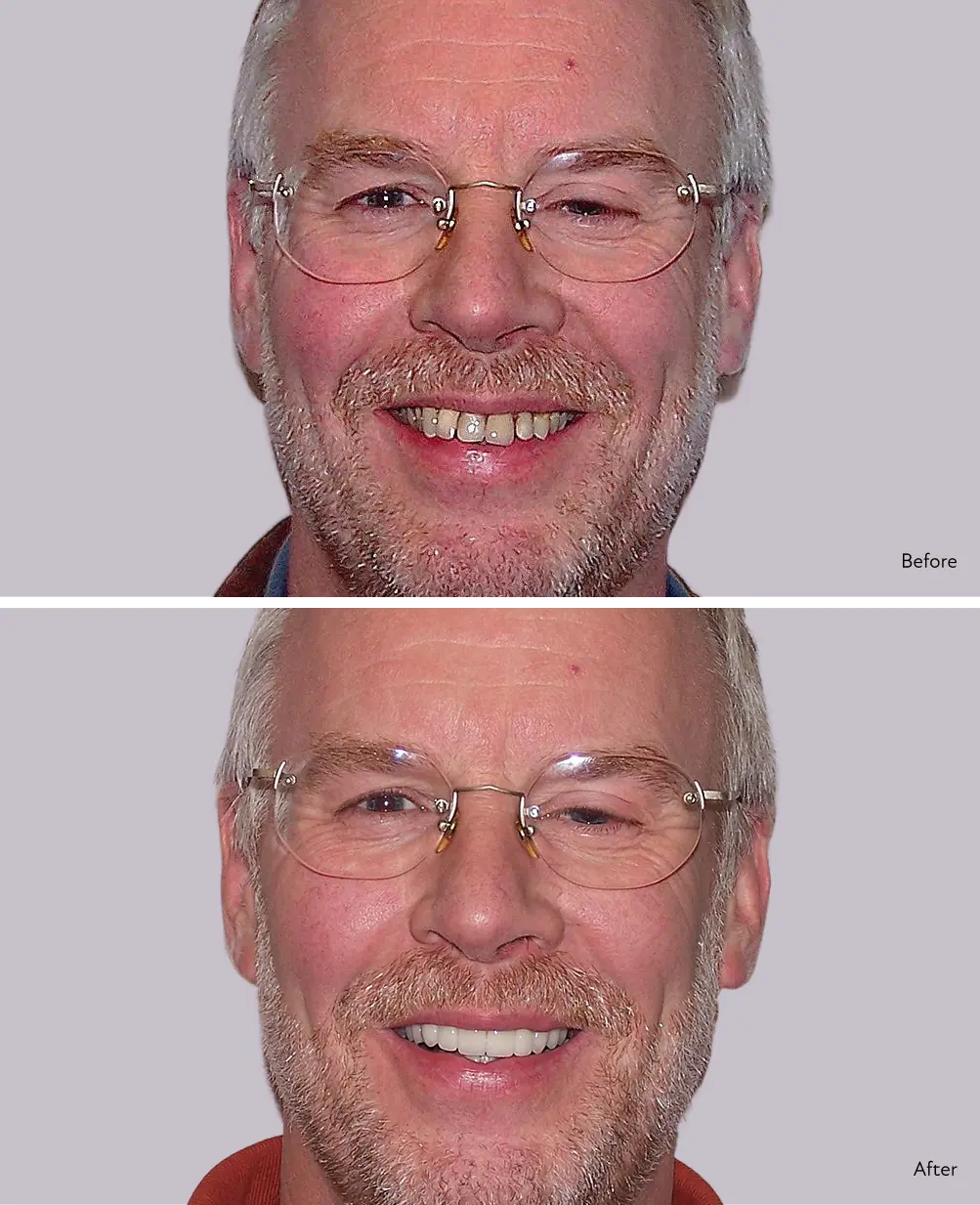 Image of patient before and after dental work