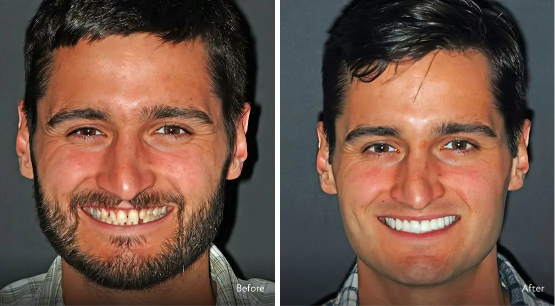 Veneers before and after