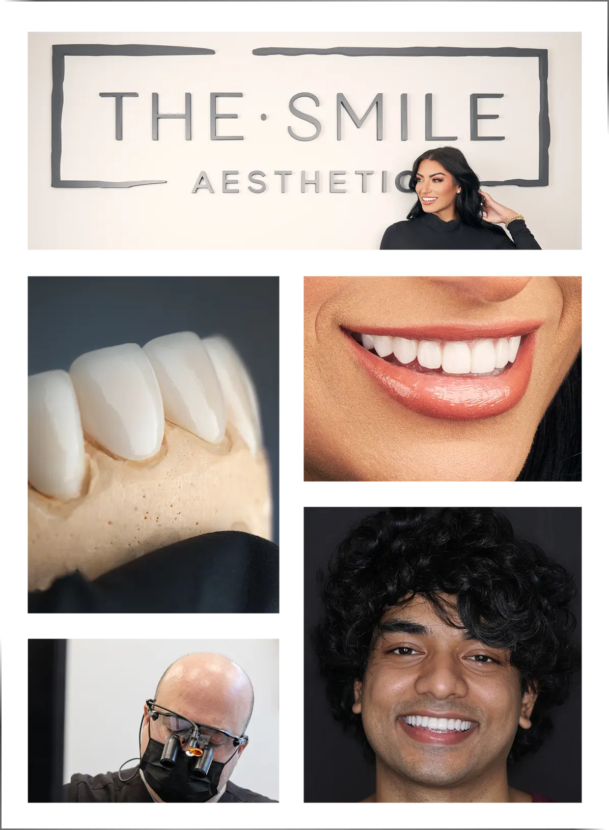 no prep veneers collage