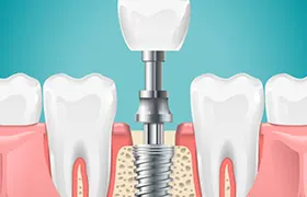 dental implant