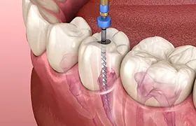 Root Canal