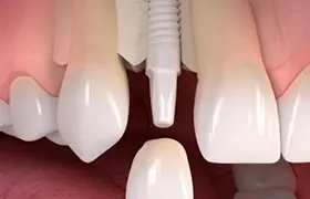 Zirconia implant graphic