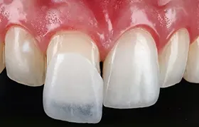Veneers