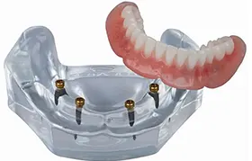 Snap Dentures