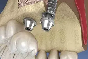 Sinus Lift