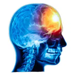 xray showing trauma to brain