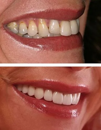 Veneer results