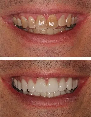 Veneer results