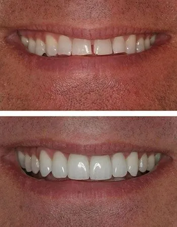 Veneers results