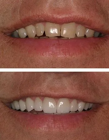 Veneers results