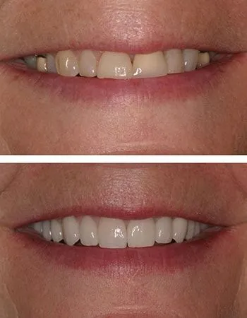 Veneers results