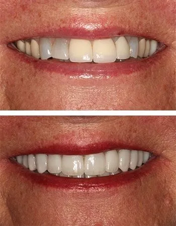 Veneers results