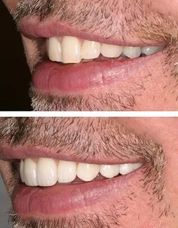 Veneers results