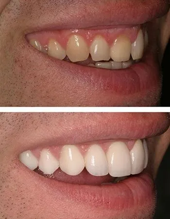 Veneers results