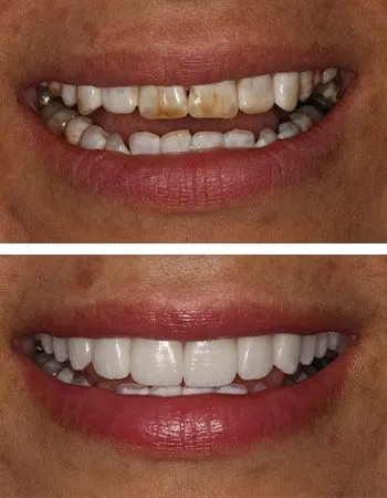Smile design results