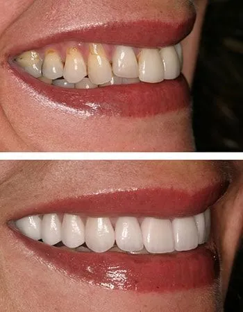 Smile design results
