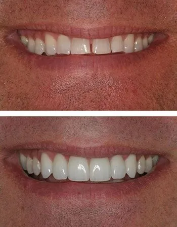 Smile design results