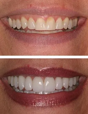 Full mouth recon results