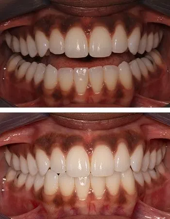 Teeth whitening results