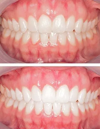 Teeth whitening results