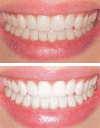 Teeth whitening results