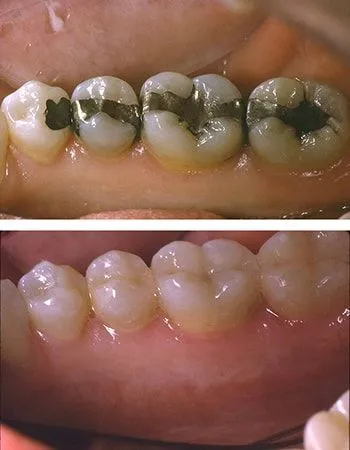 Fillings in teeth
