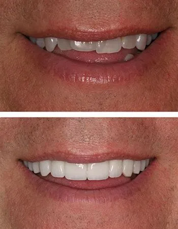 Orthodontics results