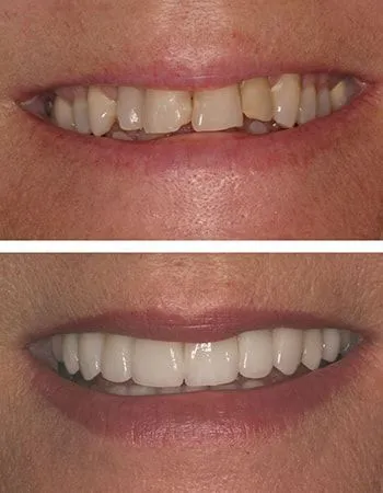 Orthodontics results