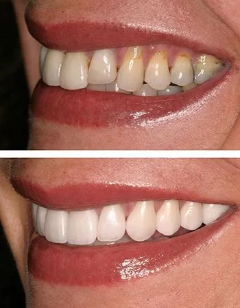 Orthodontics results