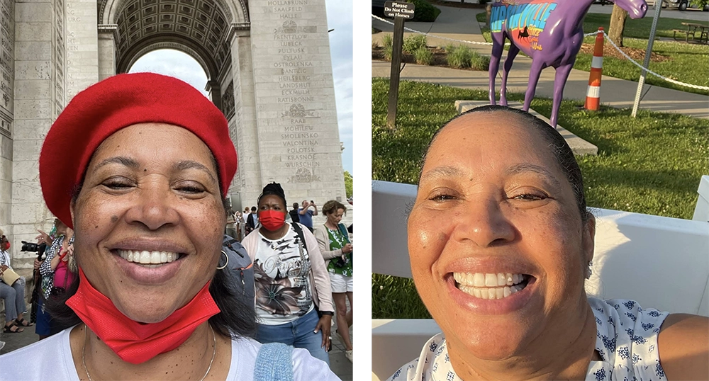 Before and after Invisalign treatment