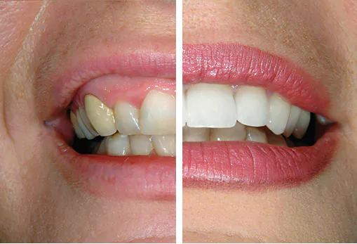 Before and after image of smile
