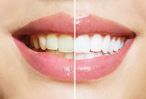 Before and after for teeth whitening