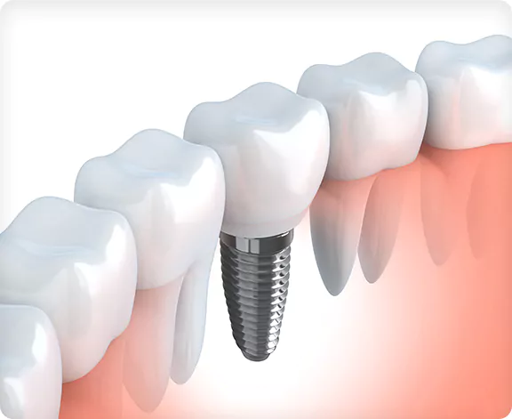 dental implant