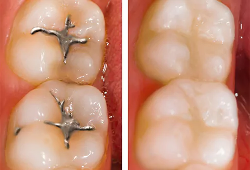 fillings