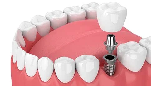 dental implant