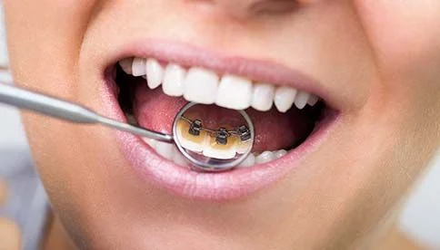 dental tool showing reflection of braces