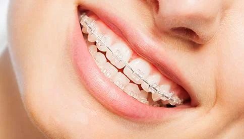 young woman's smile with ceramic braces