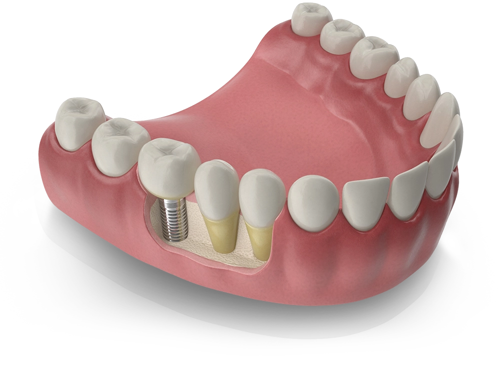 dental implant model