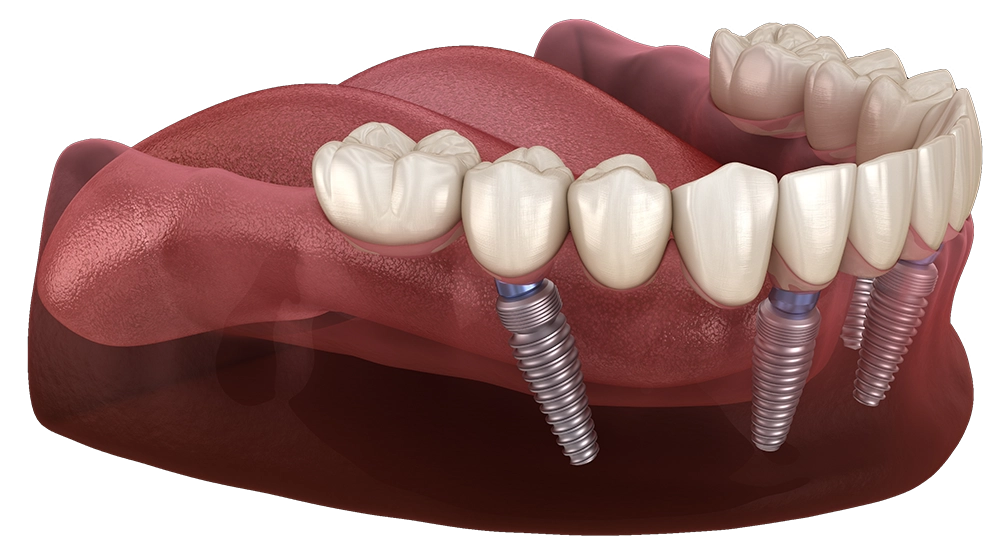 All-on-4 implants model
