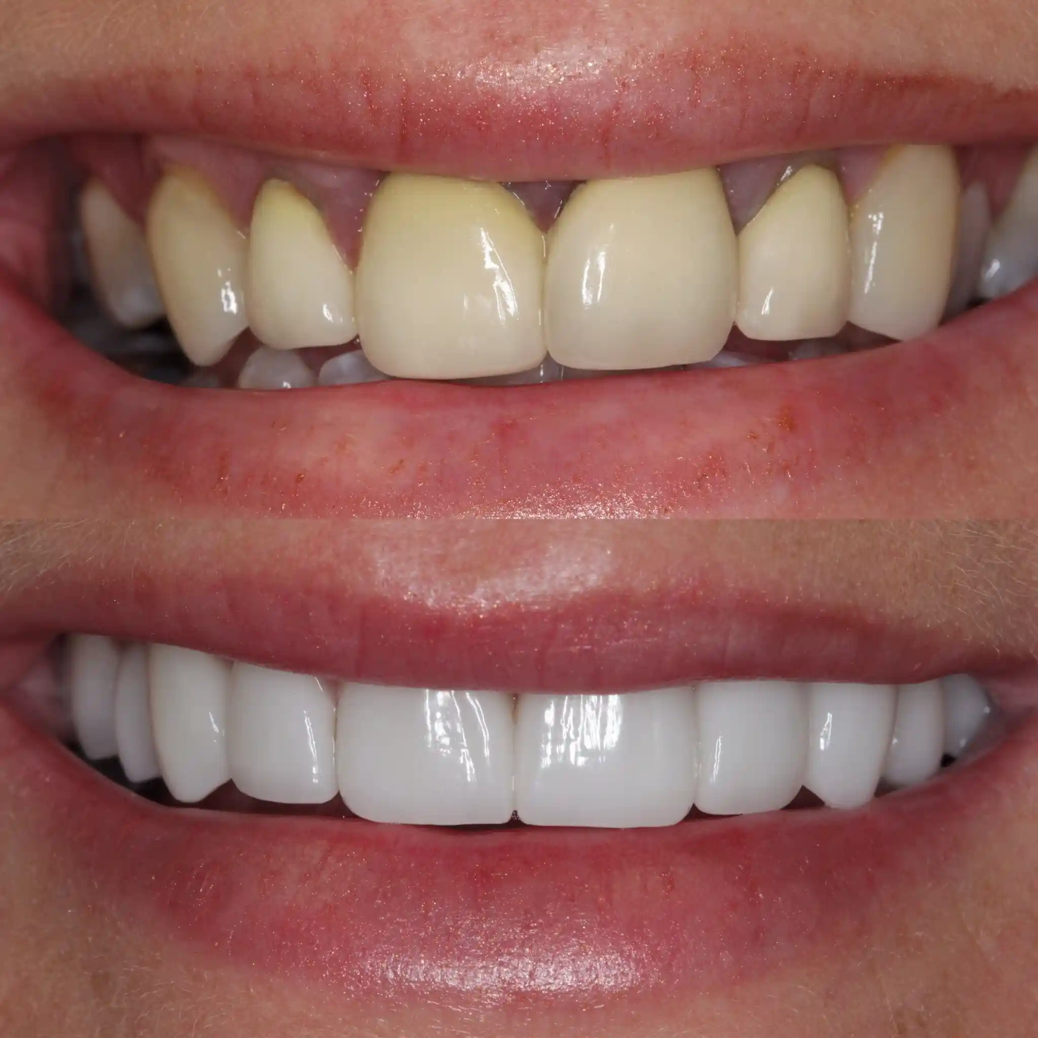 before and after crowns and bridges