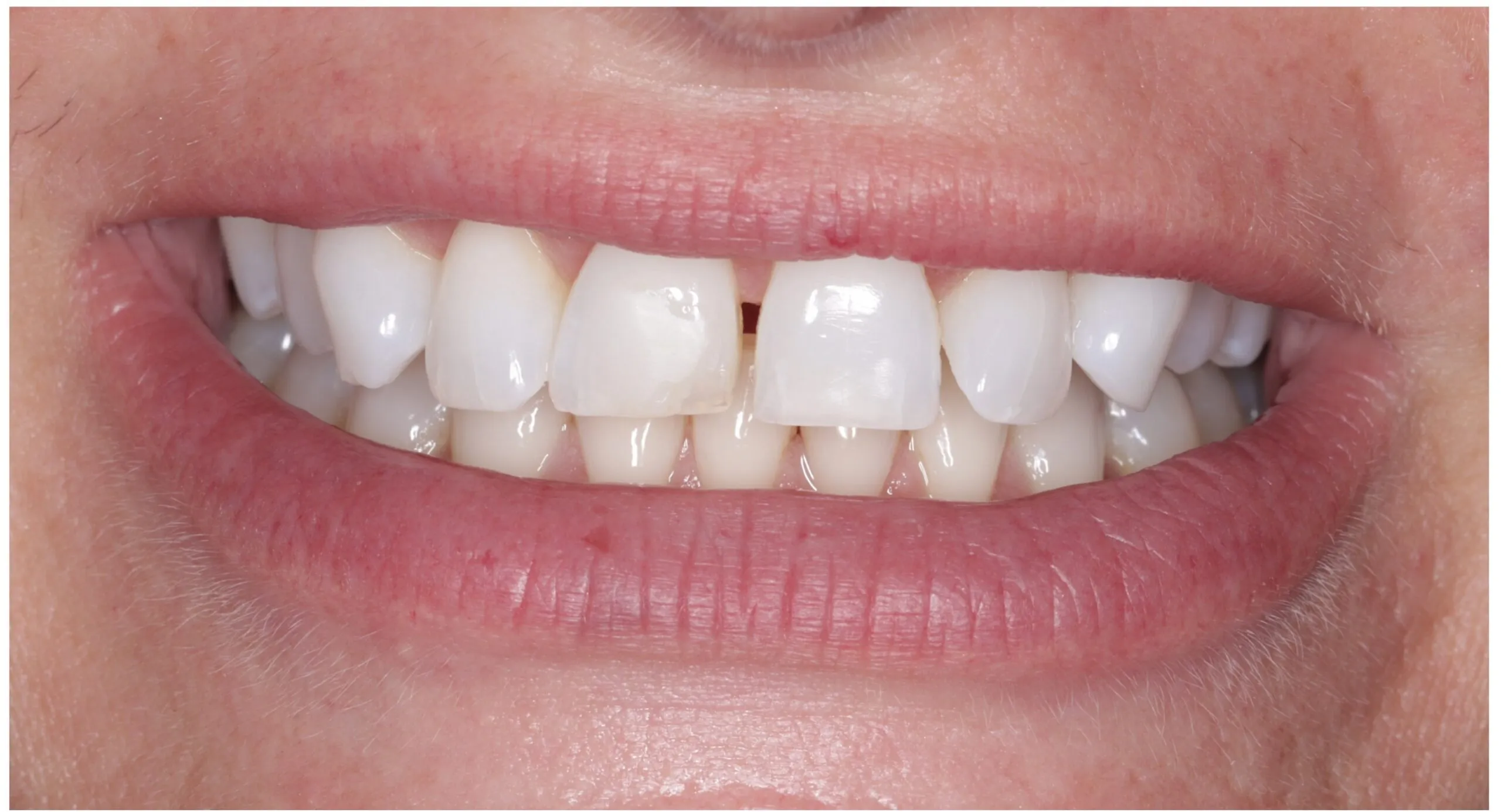 Before dental bonding